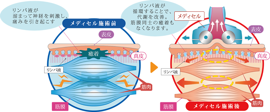 メディセル筋膜療法図